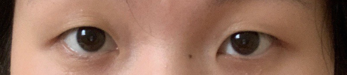 想割双眼皮,我需要要开眼角吗?