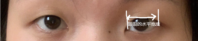 想割双眼皮,我需要要开眼角吗?