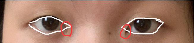 想割双眼皮,我需要要开眼角吗?