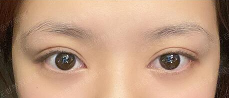 谁知道刘学源还有王世勇修复双眼皮怎么样啊?