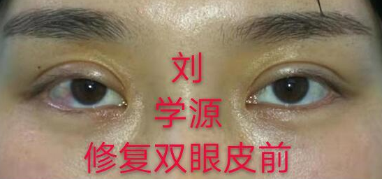 谁知道刘学源还有王世勇修复双眼皮怎么样啊?