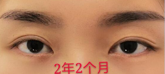 谁知道刘学源还有王世勇修复双眼皮怎么样啊?