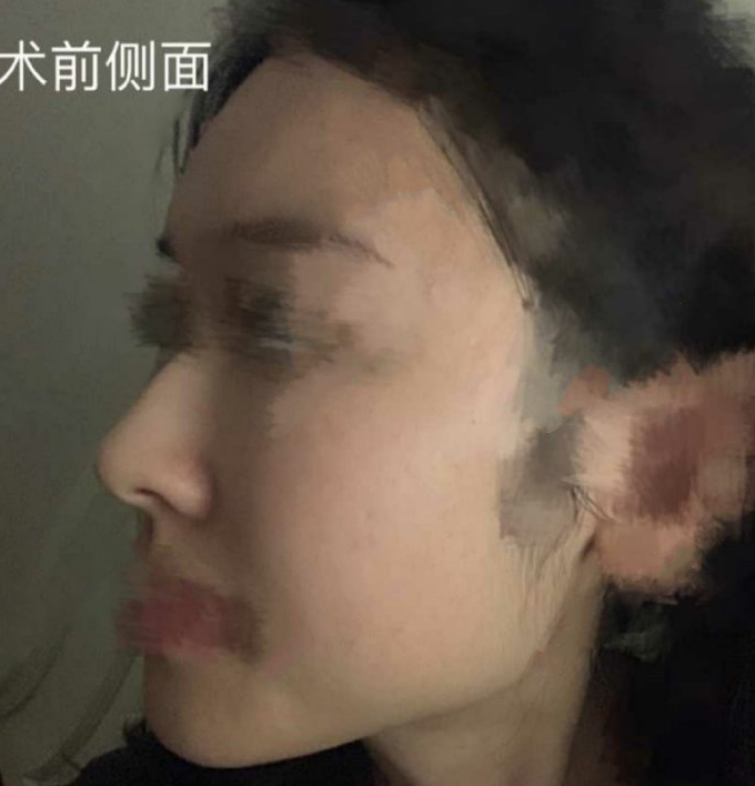北京航天医院彭喆医生下颌角+截骨前移案例|果
