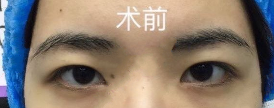 长沙彭青和医生眼部手术(开眼角、全切双眼皮、