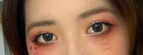 长沙彭青和医生眼部手术(开眼角、全切双眼皮、