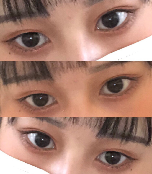 双眼皮怎么做比较好看?骨头大该削骨还是带牙