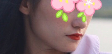 双眼皮怎么做比较好看?骨头大该削骨还是带牙