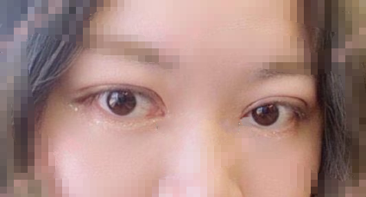 江苏省人民医院侯祚琼主任眼部手术手术案例|果