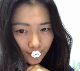 成都美莱黄小林做双眼皮手术怎么样?果|案例