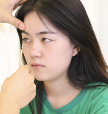 长沙罗亮做双眼皮手术怎么样?果|案例|价格
