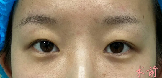 姬东硕和金奇龙两位医生双眼皮做的好吗?