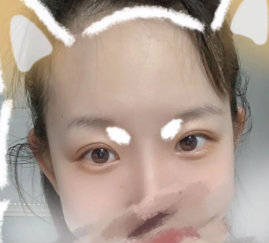 姬东硕和金奇龙两位医生双眼皮做的好吗?