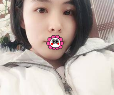 姬东硕和金奇龙两位医生双眼皮做的好吗?