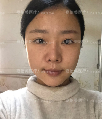 南京李国伟做面吸怎么样?果|案例|价格