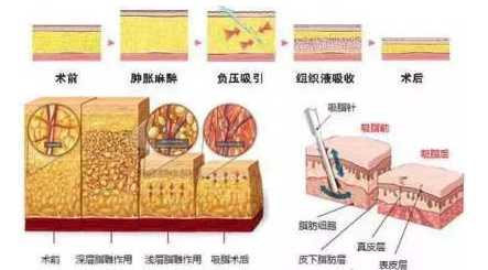 吸脂是否真的可以做到直角腰,筷子腿?