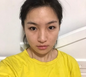 唯韩医院宋银彬医生做鼻子怎么样?