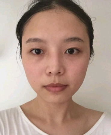华美紫馨、美莱做鼻子眼睛哪家好?果|案例