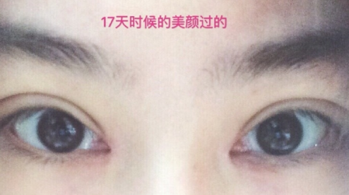 华美紫馨、美莱做鼻子眼睛哪家好?果|案例
