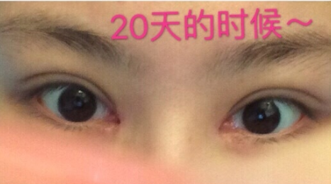 华美紫馨、美莱做鼻子眼睛哪家好?果|案例