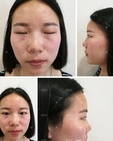 王海平和吴秀英双眼皮谁做的更好?