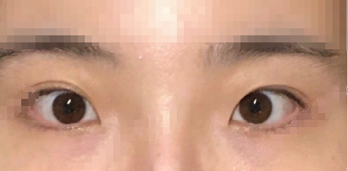 北京八大处尹琳医生双眼皮开眼角案例|果|价格
