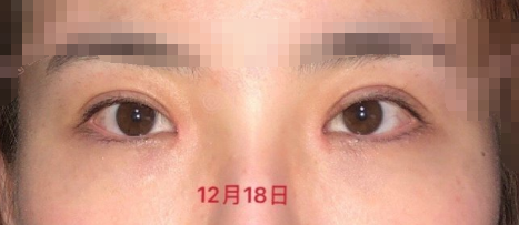 北京八大处尹琳医生双眼皮开眼角案例|果|价格