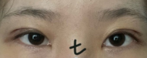 北京八大处宋维铭大夫全切双眼皮案例|果|价格