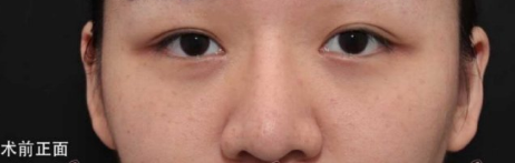 深圳罗湖艾妍徐荣阳院长半肋+膨体鼻修复案例