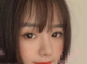 深圳罗湖艾妍徐荣阳院长半肋+膨体鼻修复案例