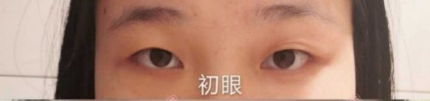 成都高新莱伊刘海兰医生韩式定点双眼皮案例|