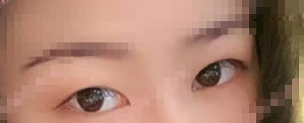 杭州群英整形外科余炽医生眶隔重置法眼部手术案