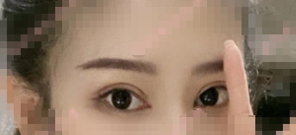 杭州群英整形外科余炽医生眶隔重置法眼部手术案