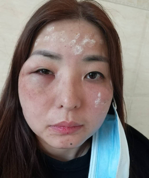 上海维九医疗美容方建蔺抗衰线-锚型线面中侧部