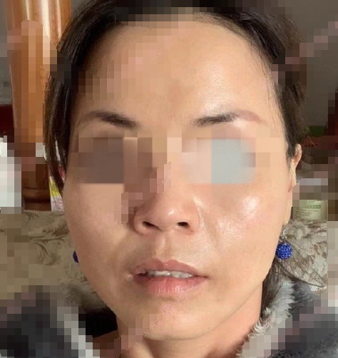 上海维九医疗美容方建蔺抗衰线-锚型线面中侧部