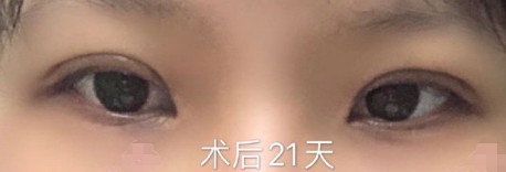 上海九院梁奕敏医生全切双眼皮案例|果|价格