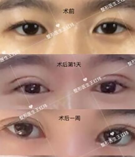 深圳博美院长王红玮做开扇形眼部手术怎么样?【