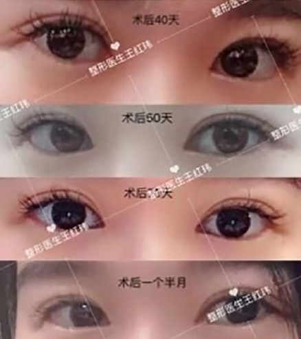 深圳博美院长王红玮做开扇形眼部手术怎么样?【