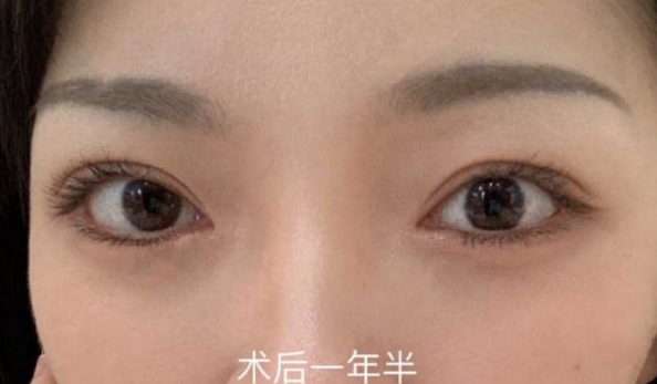 四川大学华西医院成办院银丽医生眼部手术手术案