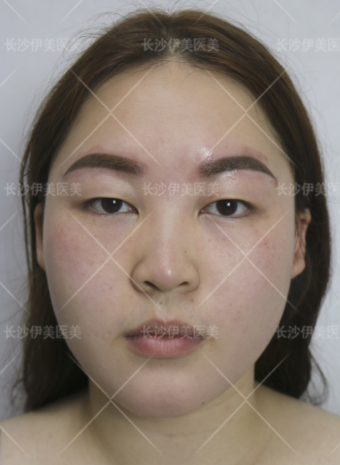 长沙伊美医疗美容刘芳医生做眼部手术怎么样?案