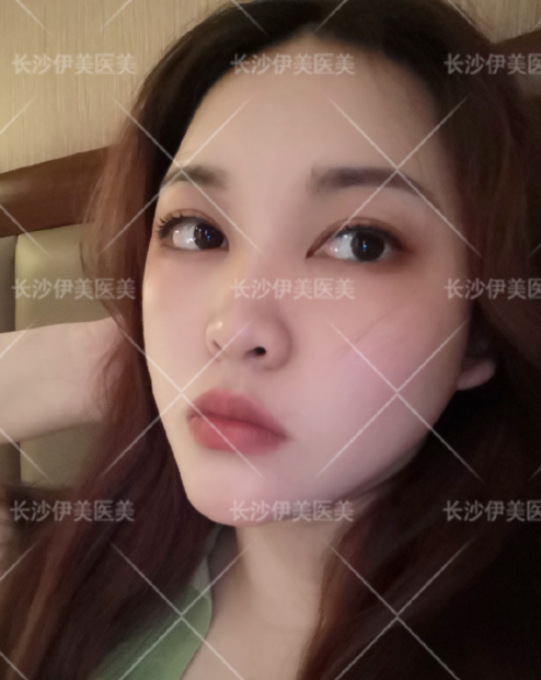 长沙伊美医疗美容刘芳医生做眼部手术怎么样?案