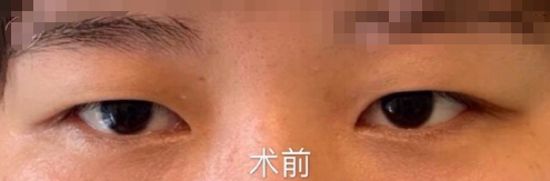 上海九院王梓医生全切双眼皮怎么样?案例|果