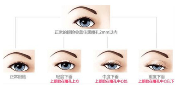 上睑下垂做个双眼皮手术就可以了吗?
