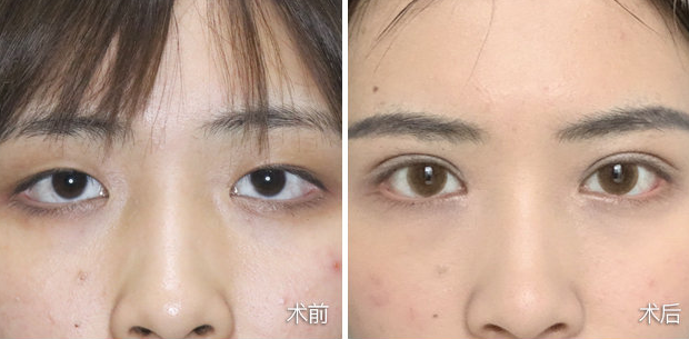 上睑下垂做个双眼皮手术就可以了吗?