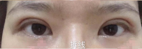 上海九院范海燕医生全切双眼皮案例|果|价格