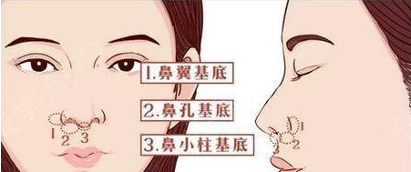 如何改良鼻基底凹陷?【鼻基底知识】