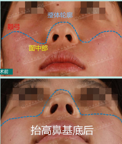 如何改良鼻基底凹陷?【鼻基底知识】
