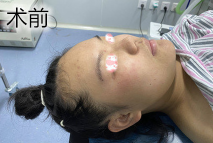 武汉华科大同济医学院张继强医生半肋隆鼻部手术