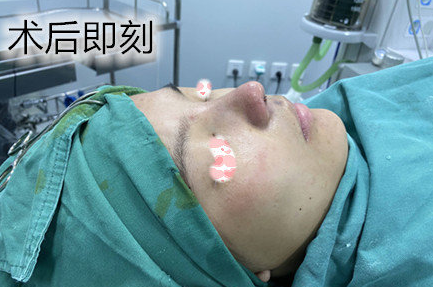 武汉华科大同济医学院张继强医生半肋隆鼻部手术