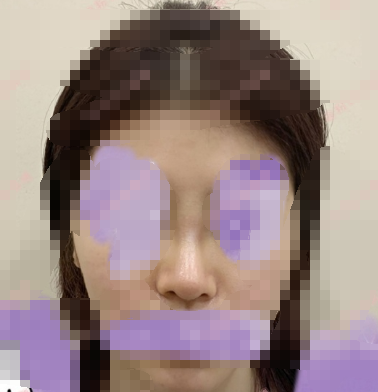 上海整形医生李昕半肋隆鼻部手术手术经验分享