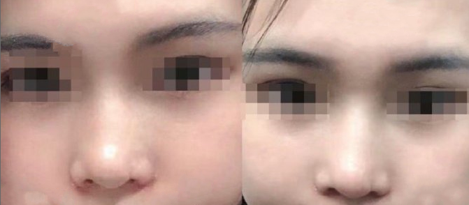 上海九院杨鹏高医生耳软骨垫鼻尖+鼻翼整形案